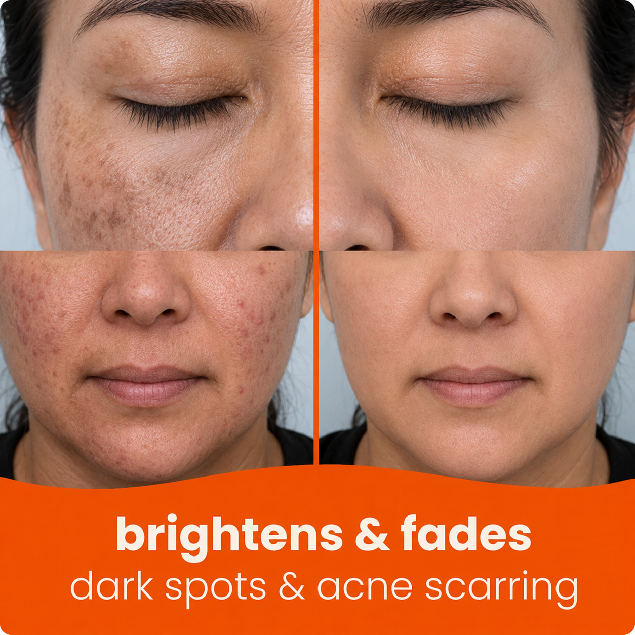 🔥Last Day 68% OFF-Markedhe Turmeric Kojic Glow Pads
